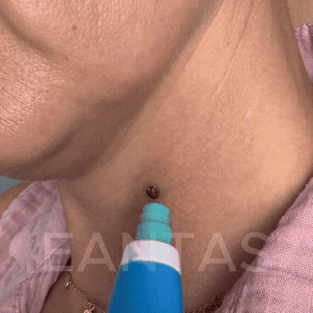 PACK ALPROMED™ - Une peau lisse en seulement 4 jours