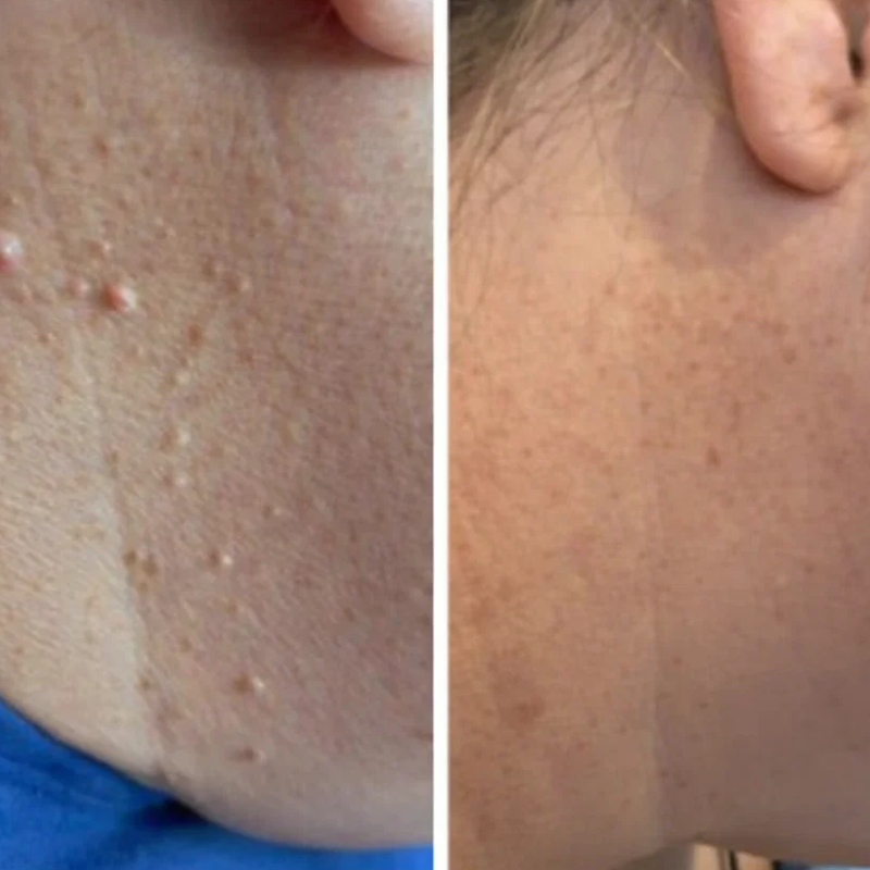 PACK ALPROMED™ - Une peau lisse en seulement 4 jours