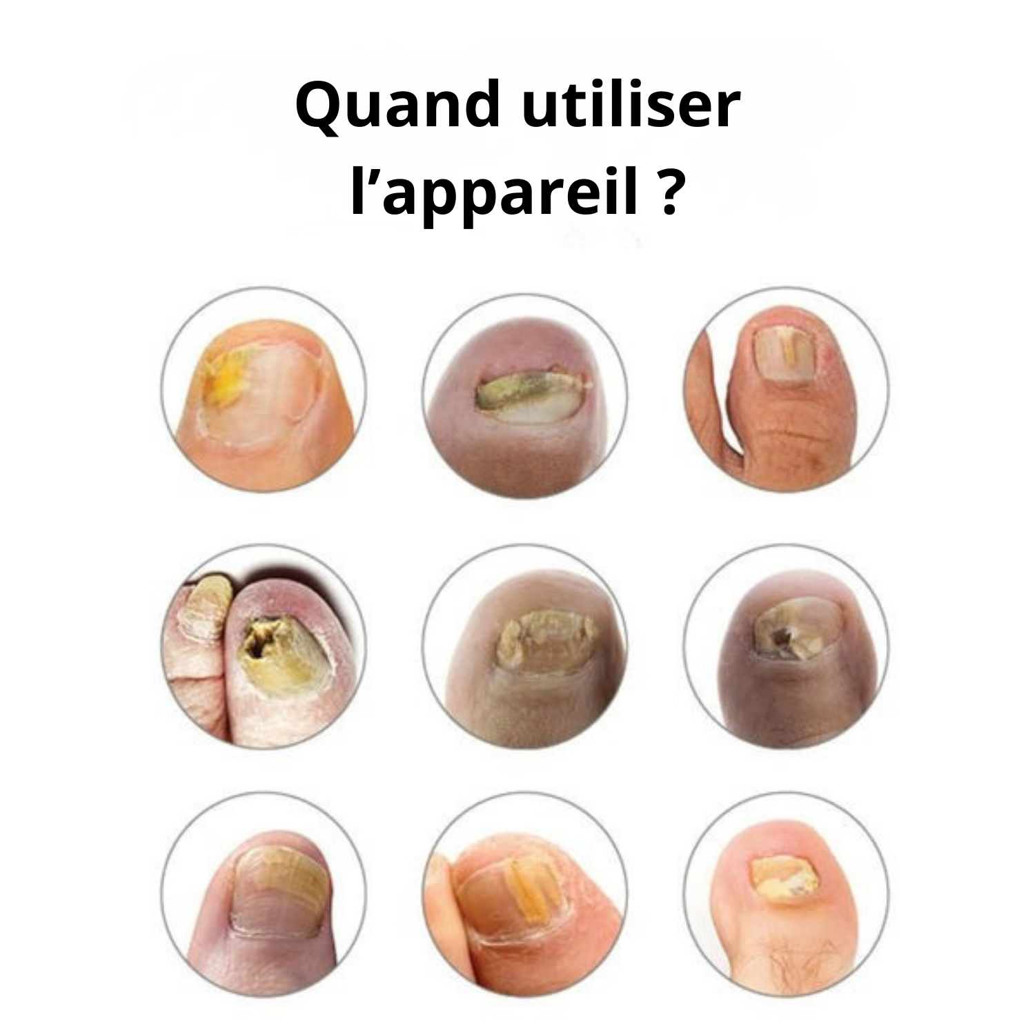 Appareil Anti-Mycose Orthomed