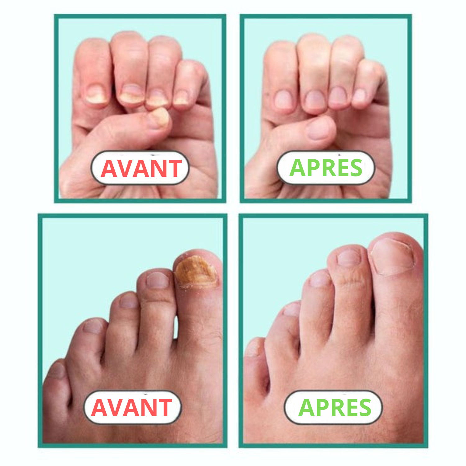 Appareil Anti-Mycose Orthomed